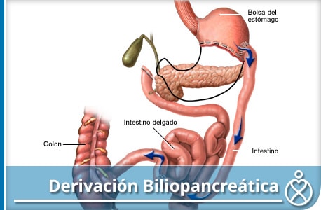 Derivación biliopancreática o procedimiento de Scopinaro