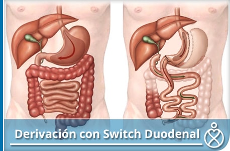 Derivación Biliopancreática con Switch Duodenal