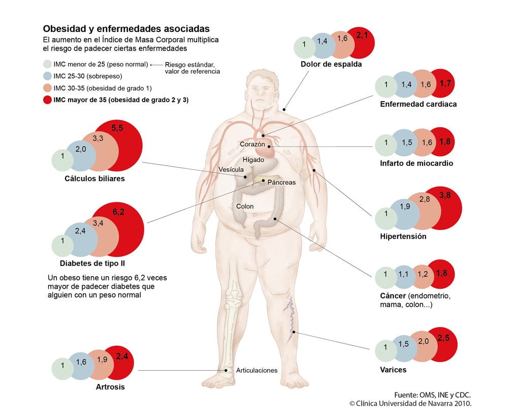 Obesidad y varices  ¿Cómo afecta el peso a las varices